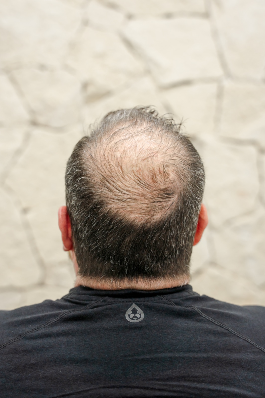 Patient before hair restoration